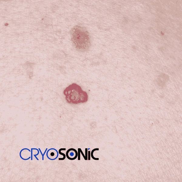 Looking for pain free cherry angioma removal treatment Sutton-in-Ashfield? Call our team today! Sutton-in-Ashfield