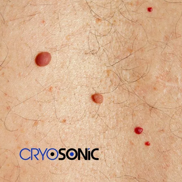 get cherry angioma removal treatment today! Sutton-in-Ashfield