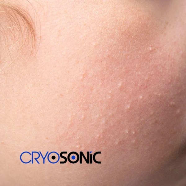Are you looking for milia removal treatment? Contact our team today Sutton-in-Ashfield