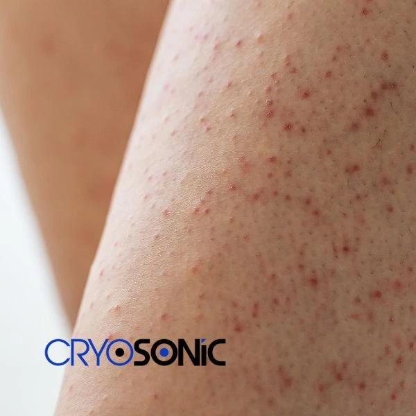 Looking for Seborrhoeic Keratosis removal Sutton-in-Ashfield treatment? Call our consultants today in Sutton-in-Ashfield