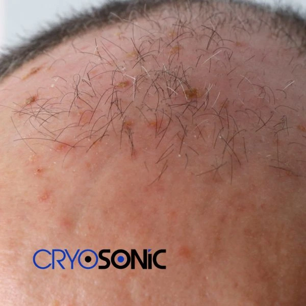 Access Seborrhoeic Keratosis removal from the comfort of your own home! Call us today in Sutton-in-Ashfield