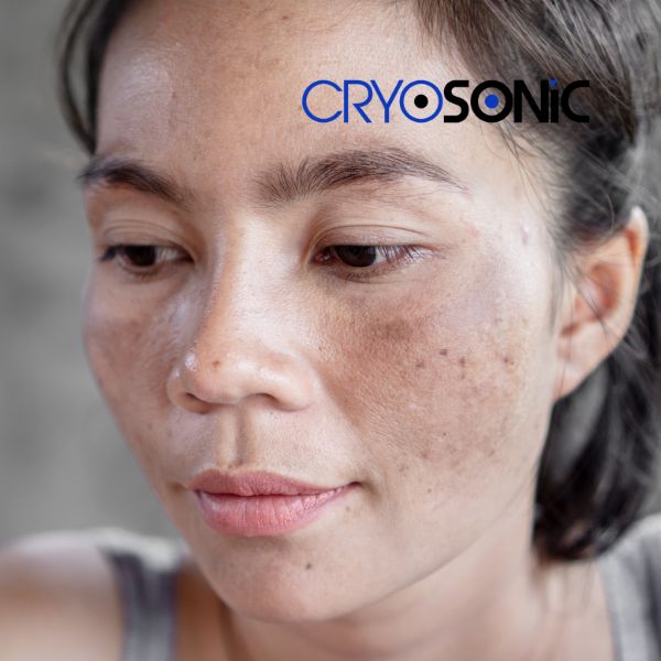 Ready to start age spots removal? Contact our team today in Sutton-in-Ashfield