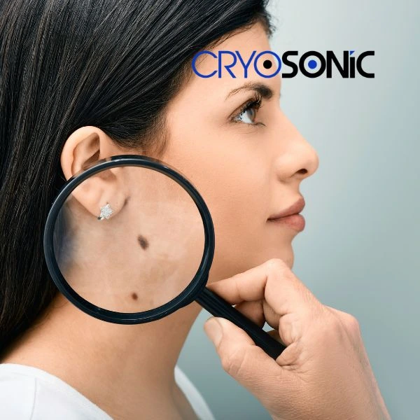 Do you want to learn more about benign moles removal treatment? Call our team today Sutton-in-Ashfield