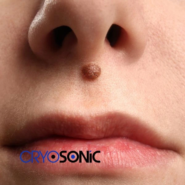 Start your benign moles removal treatment today Sutton-in-Ashfield