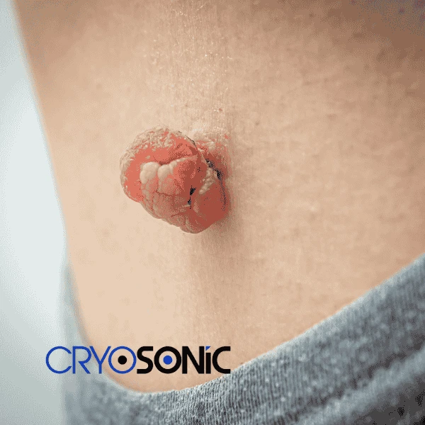 Book your skin tags removal Sutton-in-Ashfield from comfort of your own home! Sutton-in-Ashfield