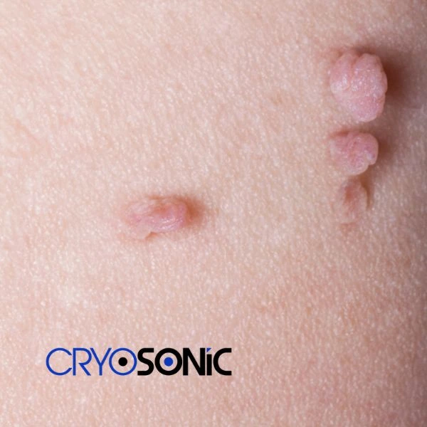 Are you looking for fast effect skin tag removal Sutton-in-Ashfield? Book in NOW! Sutton-in-Ashfield