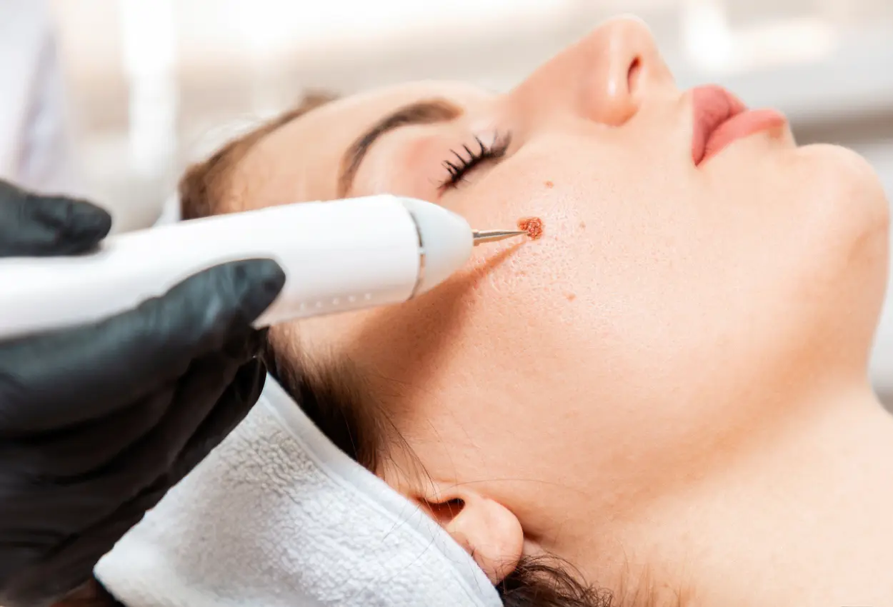 Frequently Asked Questions About Multiple Cryotherapy Treatments Sutton-in-Ashfield