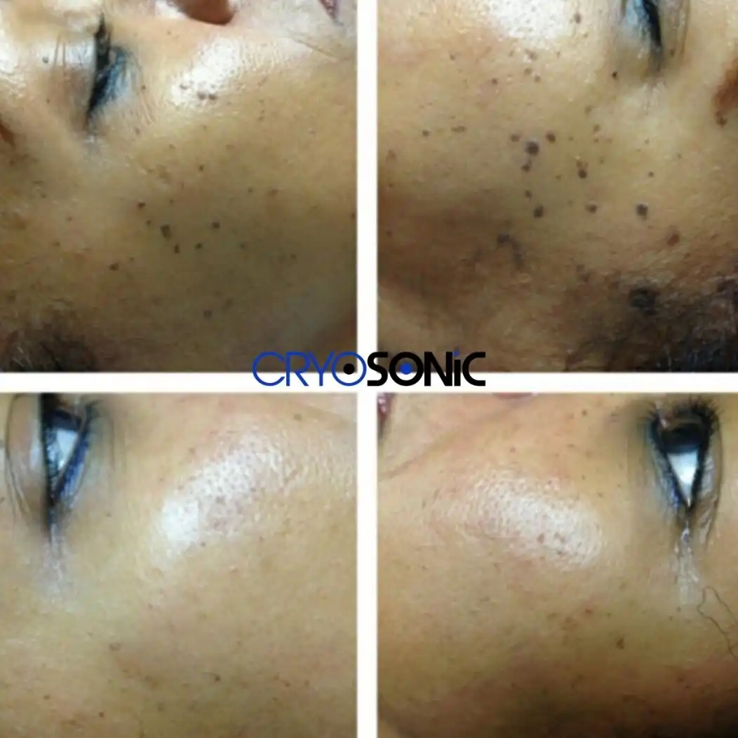Why Skin Shows Pigmentation After Treatment Sutton-in-Ashfield