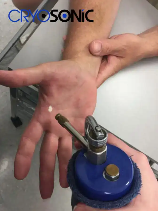 Temperature Differences: OTC vs Medical-Grade Cryotherapy Sutton-in-Ashfield